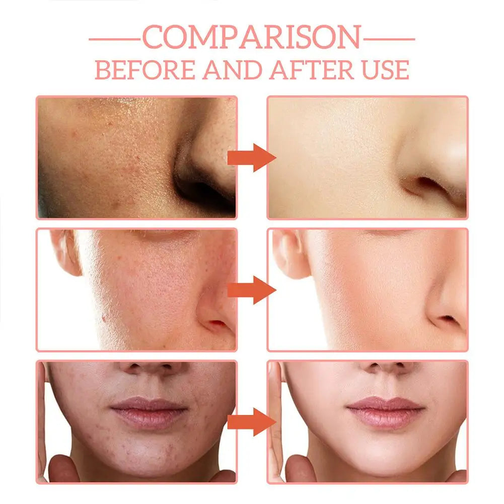 Sérum Facial 5 en 1 – Vitamina C, Ácido Hialurónico, Reafirmante, Iluminador y Reductor de Poros