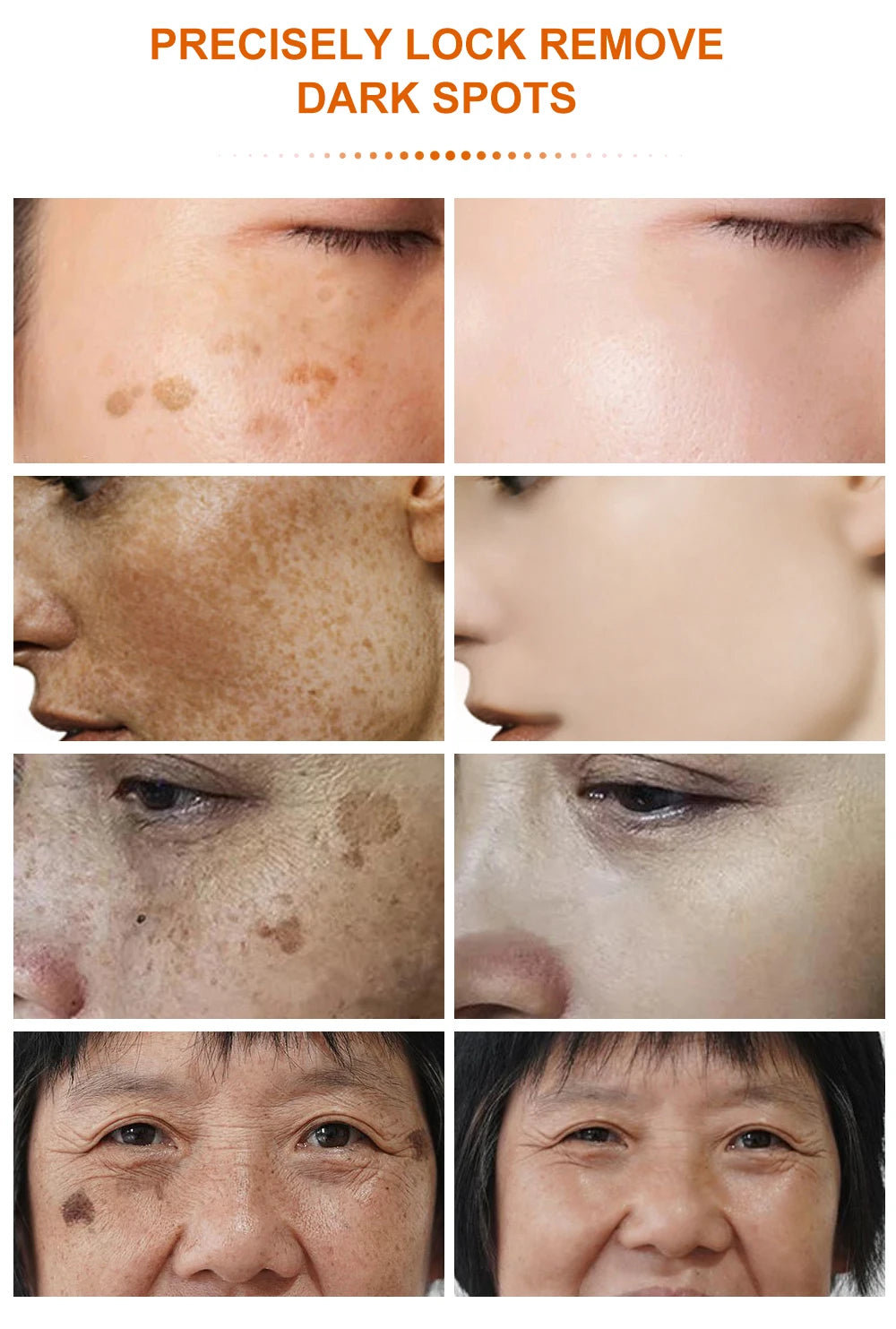 Vitamins Remove Dark Spots Lighten Sun Spots Freckles Melasma Pigmentation Whitening Cream Anti-Aging Brightening Skin Care 40g