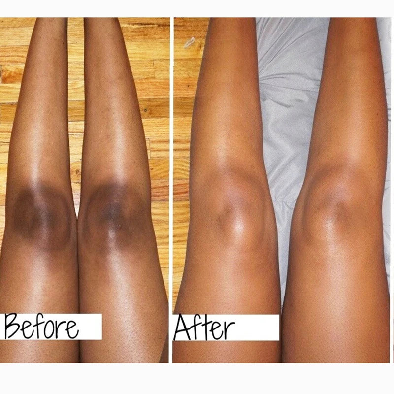 Anti Acanthosis Nigricans Whitening Cream Remove Melanin Armpit Elbow Private Care Products Body Butt Black Sitting Print Remove