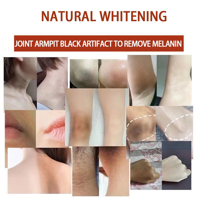 Anti Acanthosis Nigricans Whitening Cream Remove Melanin Armpit Elbow Private Care Products Body Butt Black Sitting Print Remove