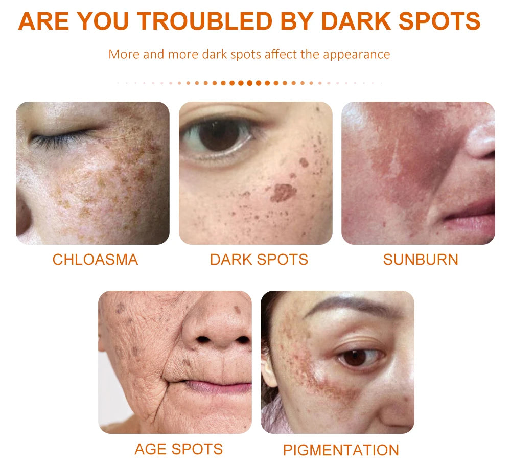 Vitamins Remove Dark Spots Lighten Sun Spots Freckles Melasma Pigmentation Whitening Cream Anti-Aging Brightening Skin Care 40g